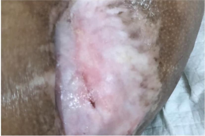 After treatment